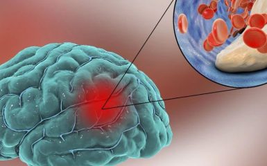 每12秒就有一人死于该病，而日本患者过半都能康复，中国患者却80%术后不能自理，原因是什么？